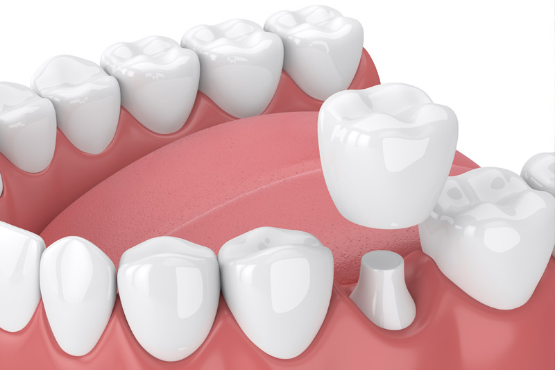 Dental Crowns in Easton