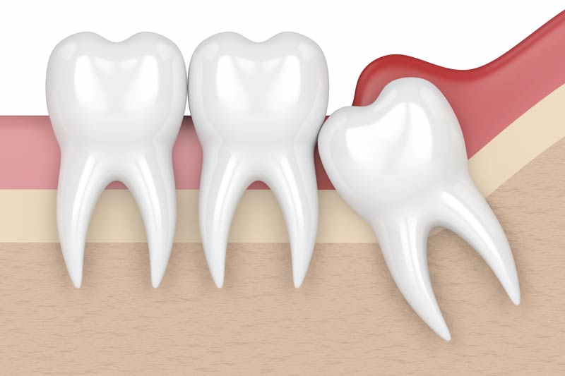 Wisdom Tooth Removal in Easton